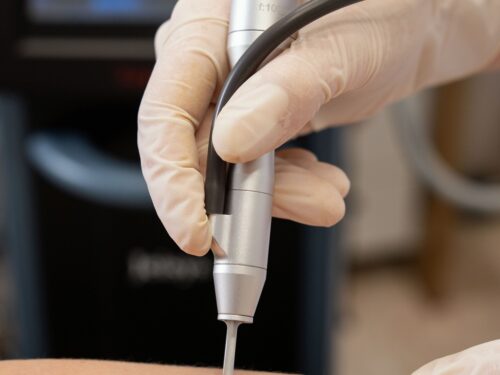 Odos darinių šalinimas lazeriu Kaune