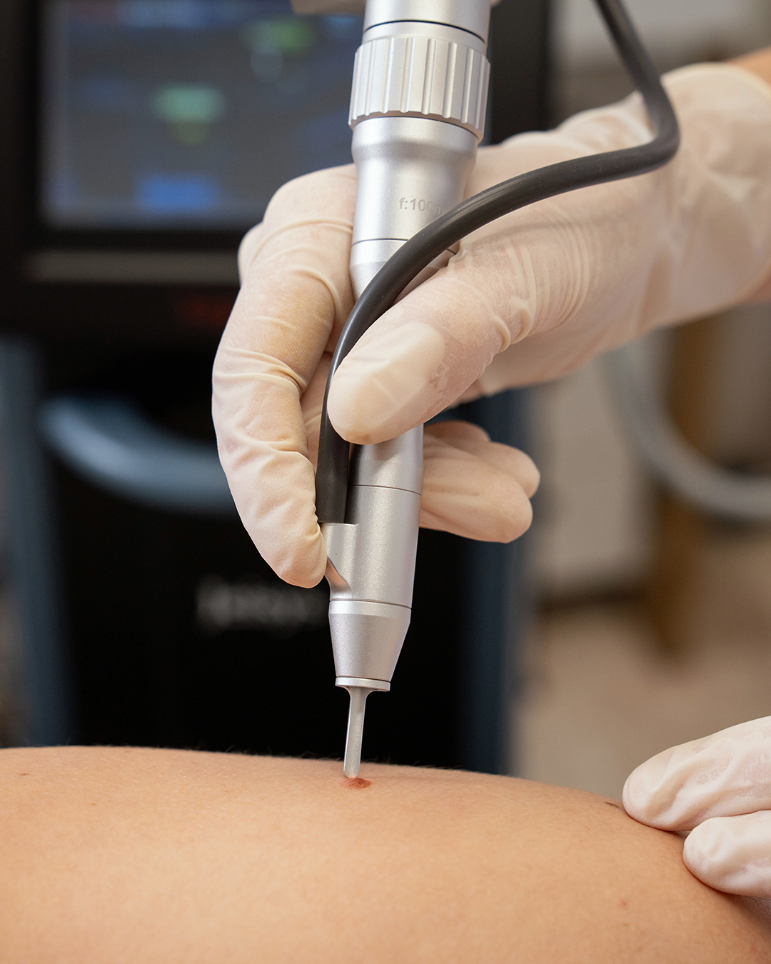 Apgamų, papilomų ir kitų odos darinių šalinimas lazeriu Kaune